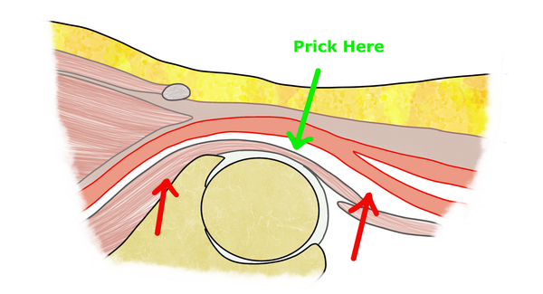 When to Use Antegrade Access in Infrainguinal Revascularization