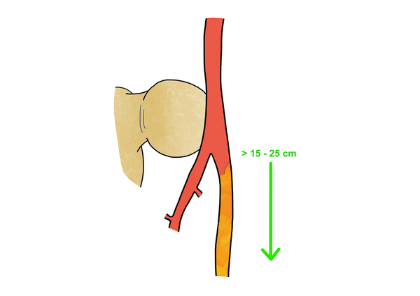Schematic representation of a long femoropopliteal chronic total occlusion exceeding 15-25 cm, the morphological hallmark of TASC II D and GLASS FP grade 4 lesions