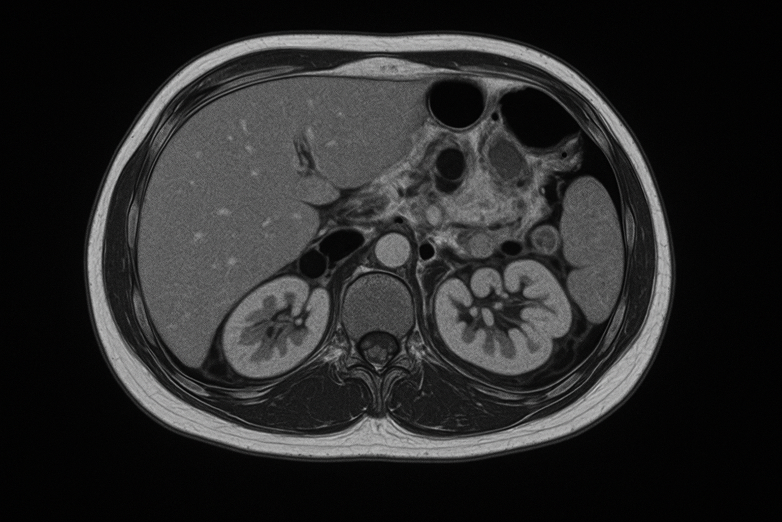 At What Point Does Visceral Fat Accumulation Start?