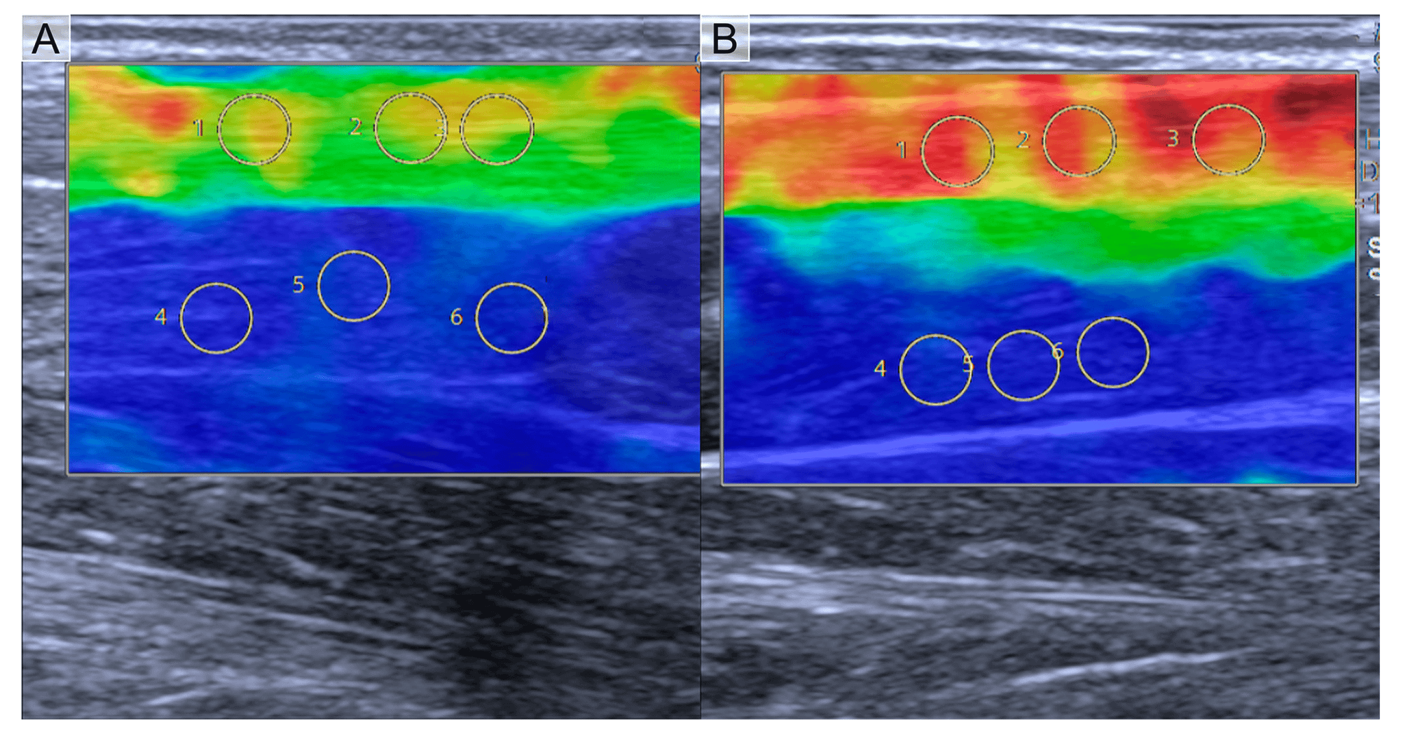 Can Science Track Changes In Tendons?