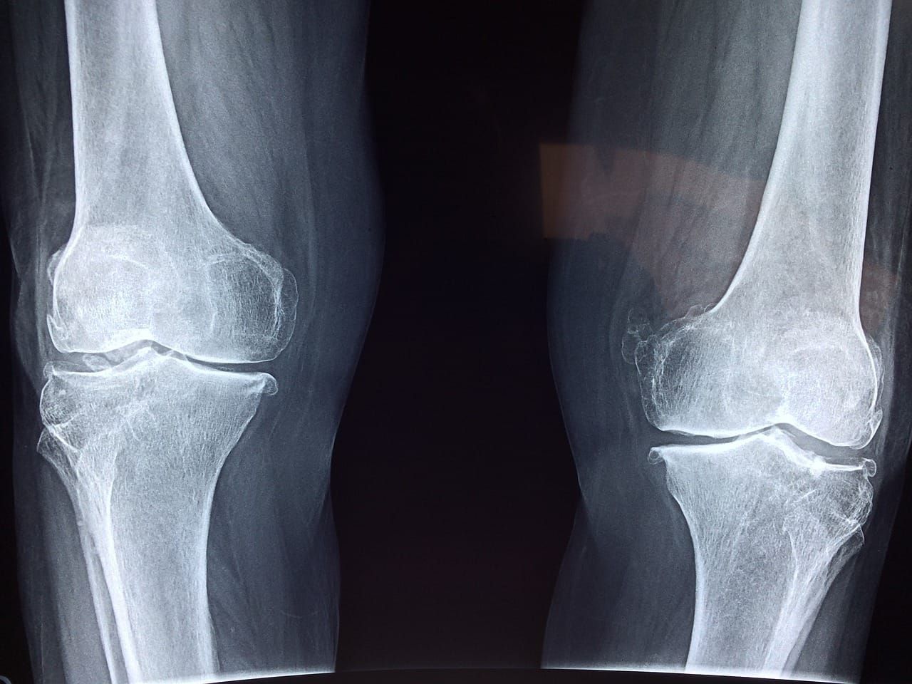 Can Adults Build Bone and What Is The Muscle To Bone Ratio?