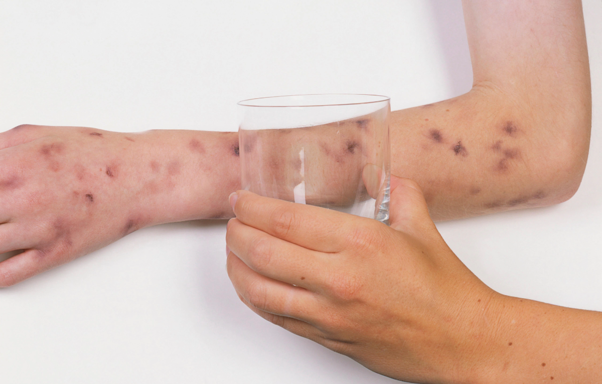 Clear glass pressed against a child’s arm with a purpuric rash to check for non-blanching spots.