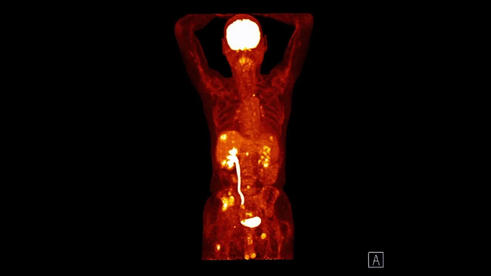 Whole-body PET image from a PET-CT scan showing areas of radiotracer uptake.