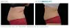 EmSculpt