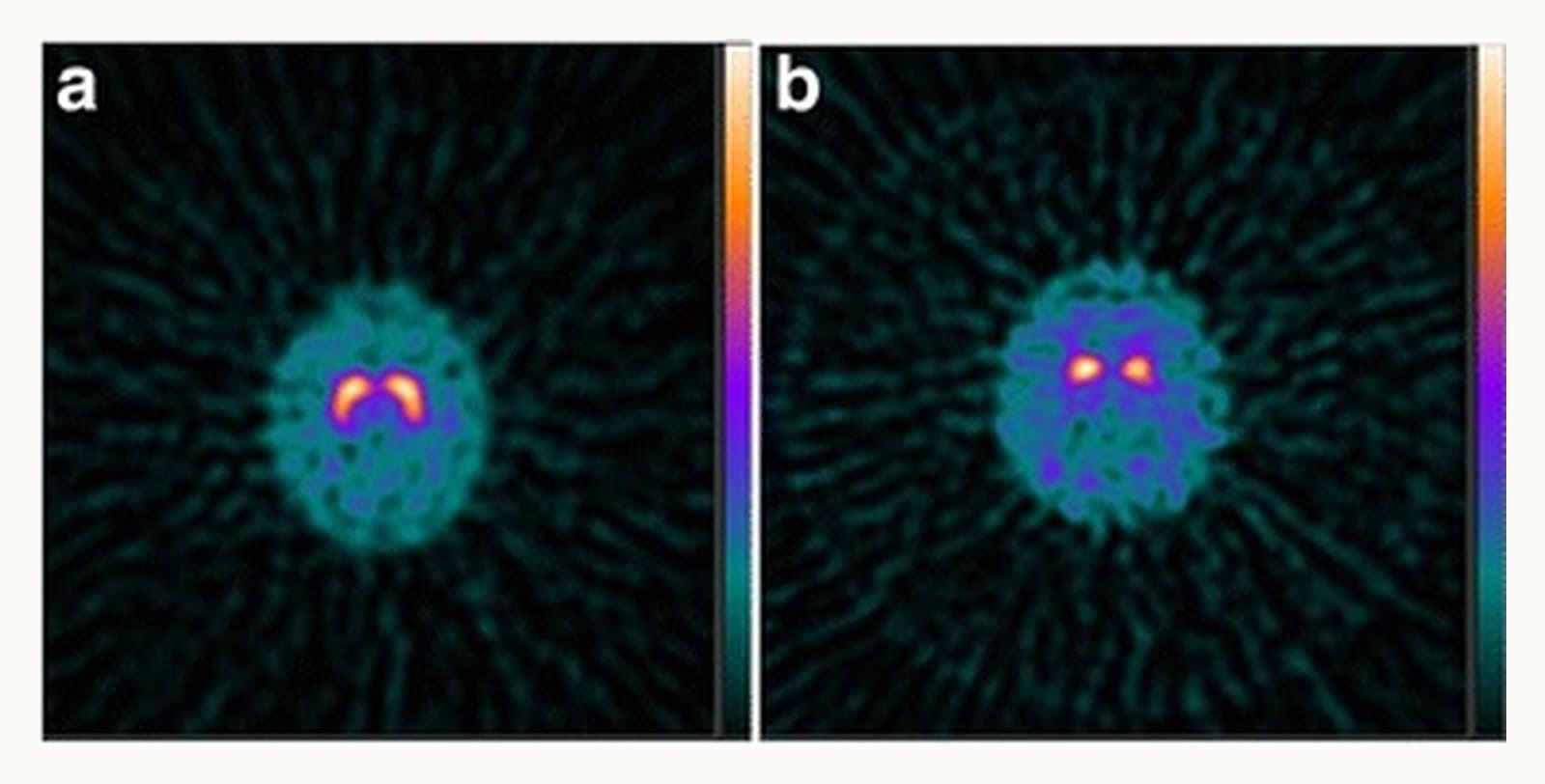 Two brain scans of dopamine nerve endings: bright comma shapes in a normal scan, smaller dimmer spots in Parkinson's.