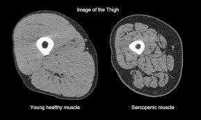 BIOKEMIJSKI KANIBALIZAM: SARKOPENIJA, MENOPAUZA I KRAH KOŠTANO-MIŠIĆNE ARHITEKTURE