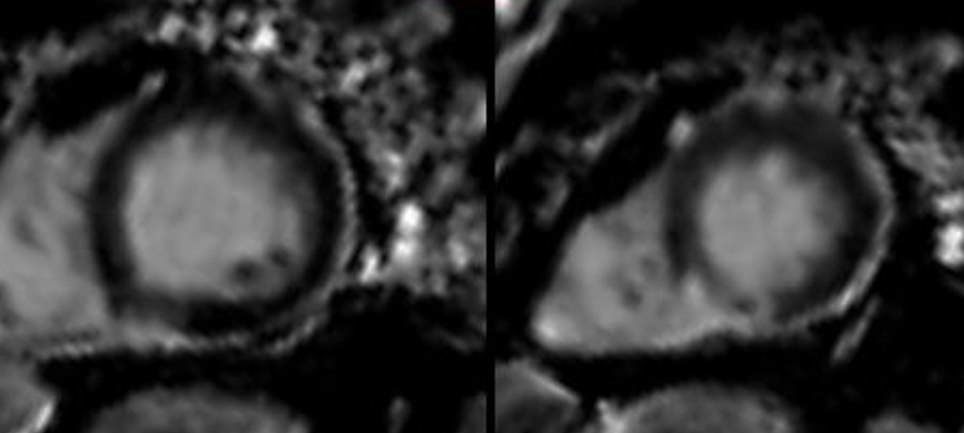 MI with normal coronaries