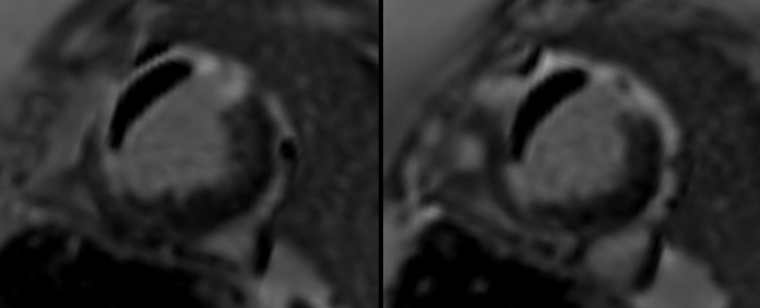 CMR in morbid Obesity