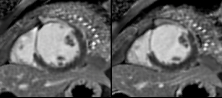 Stress Perfusion CMR