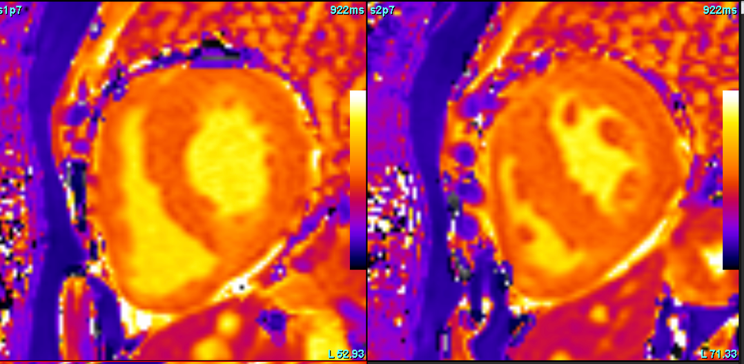 Heart failure work up