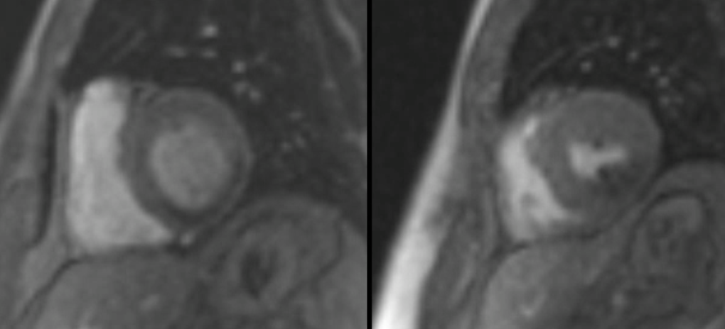 Semiquantitative perfusion analysis