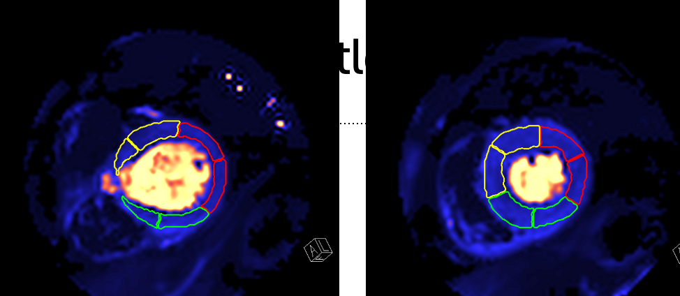 CMR quantitative perfusion