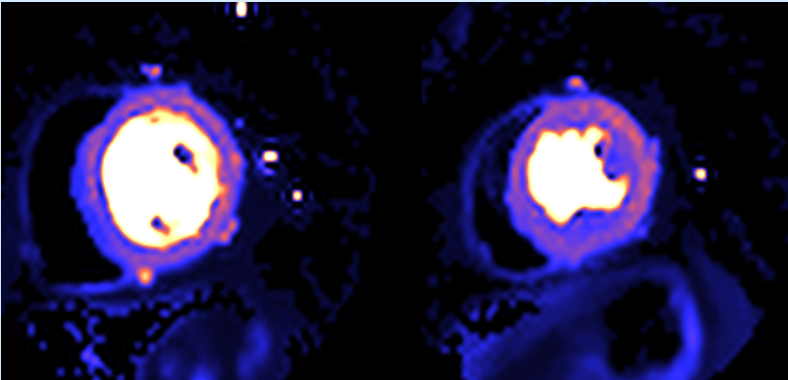 Quantitative perfusion:Case