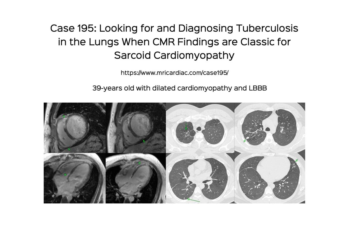 Case 195: Looking for and Diagnosing Tuberculosis in the Lungs When CMR Findings are Classic for Sarcoid Cardiomyopathy