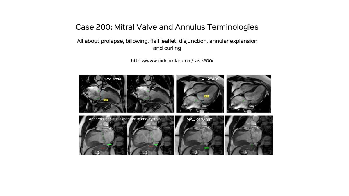 Case 200: Mitral Valve and Annular Terminologies