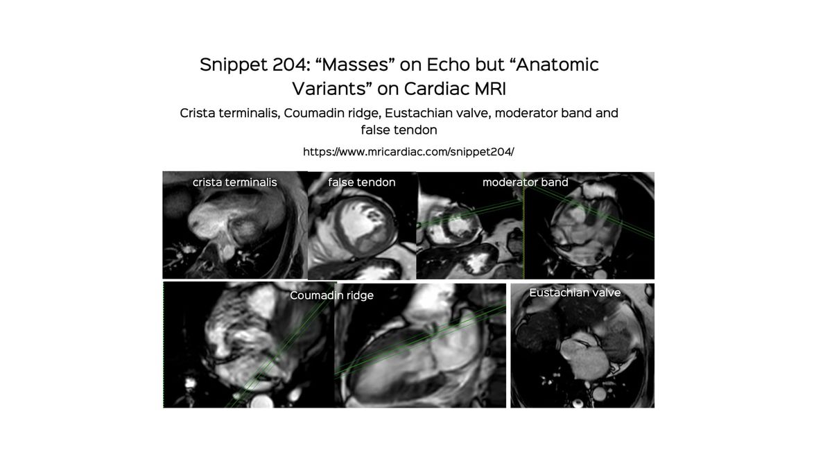 Snippet 204: "Masses" on Echo but Anatomic Variants on Cardiac MRI