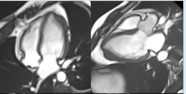 Not all hypetrophy is same!