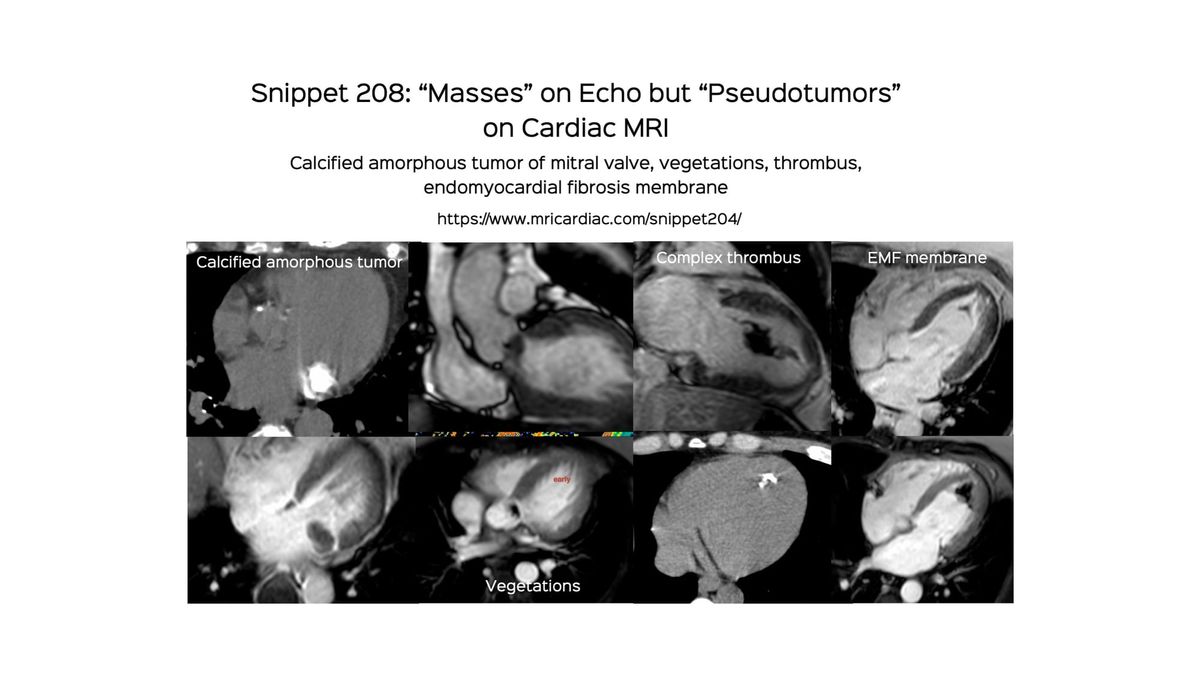 Snippet 208: Pseudotumors