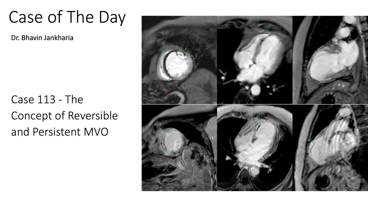 Case of the Day 113 - The Concept of Reversible and Persistent MVO