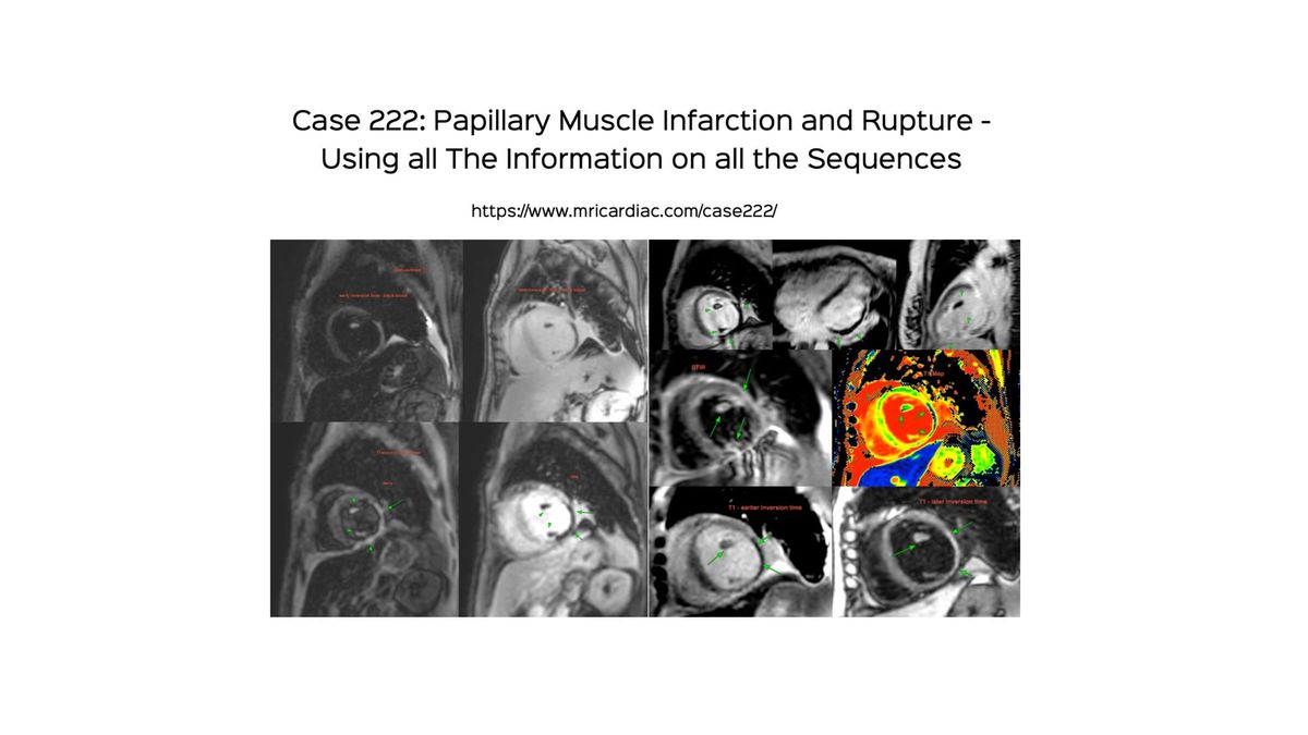 Case 222: Papillary Muscle Infarction - Using All the Information on All the Sequences