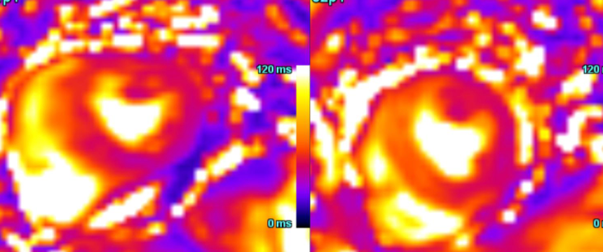 MI classification revisited