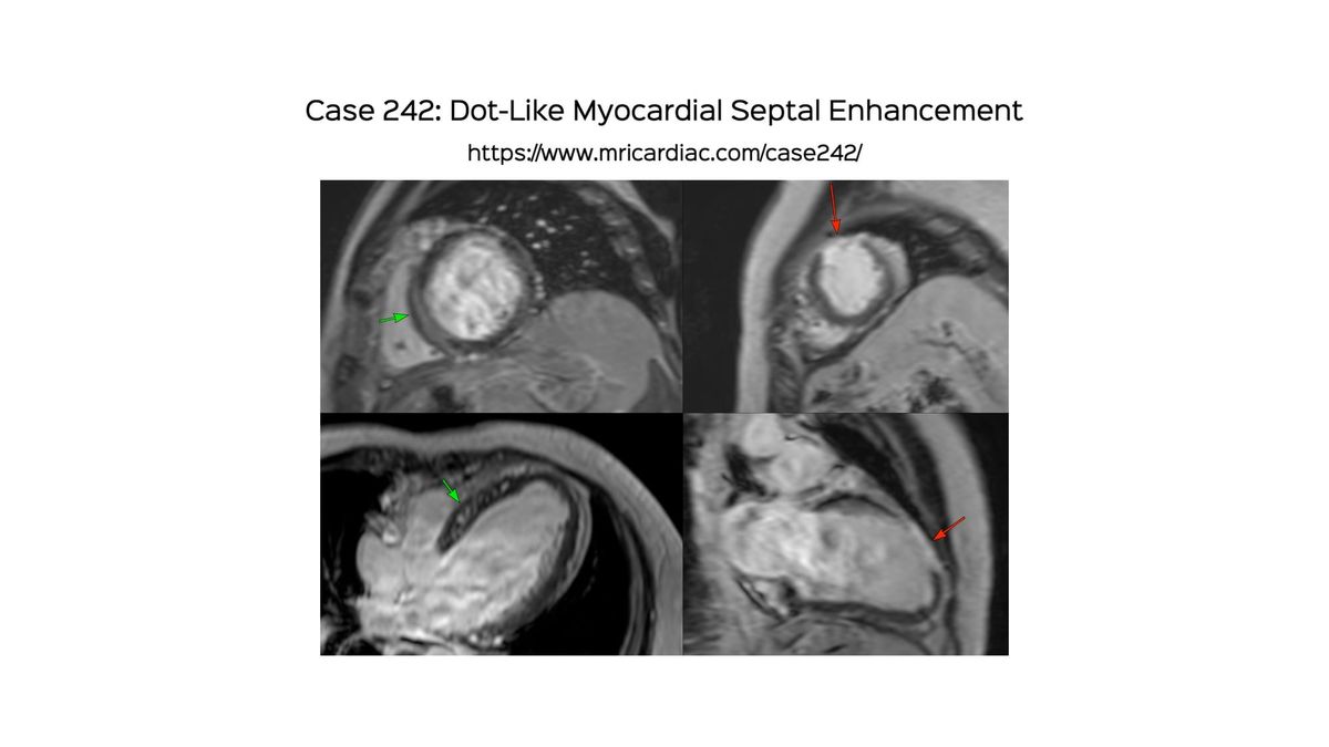 Case 242 - Dot-Like Myocardial Septal Enhancement
