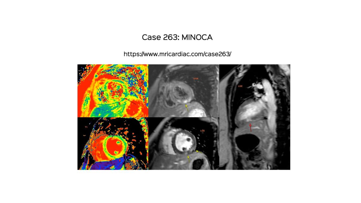 Case 263 - MINOCA
