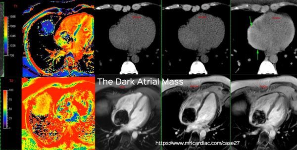The Dark Atrial Mass