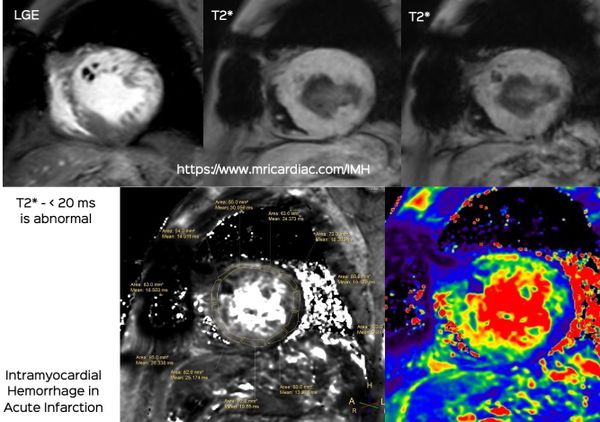 Intramyocardial Hemorrhage in Acute Infarction