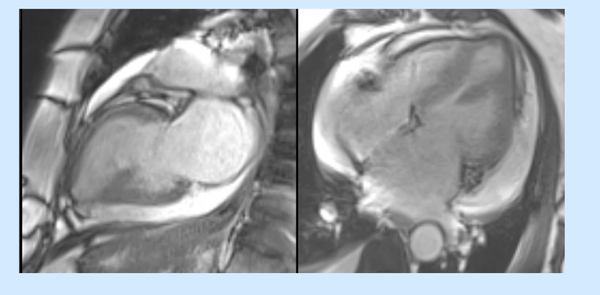 Drug-induced cardiotoxicity