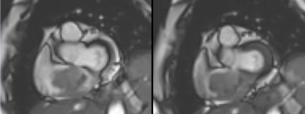 Rare intra-cardiac mass