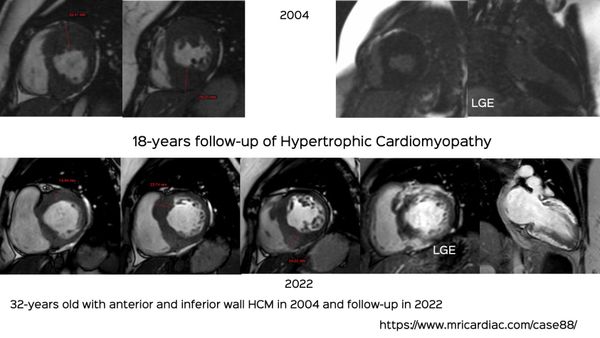Case 88: Hypertrophic Cardiomyopathy – 18 Years CMR Follow-Up