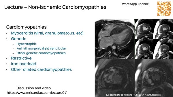 Lecture: Non-Ischemic Cardiomyopathies