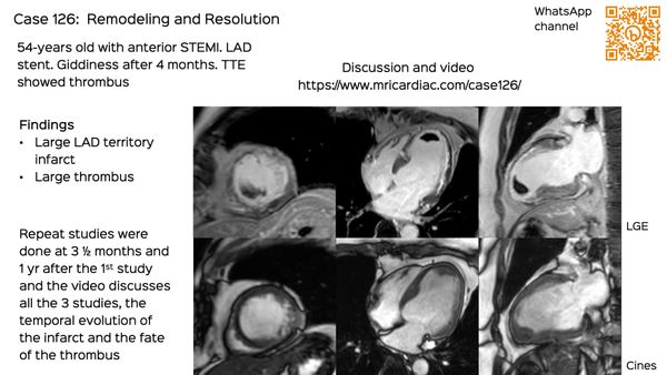 Case 126: Remodeling and Resolution
