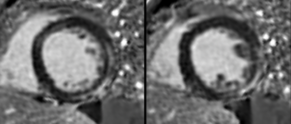 All myocarditis are not the same!