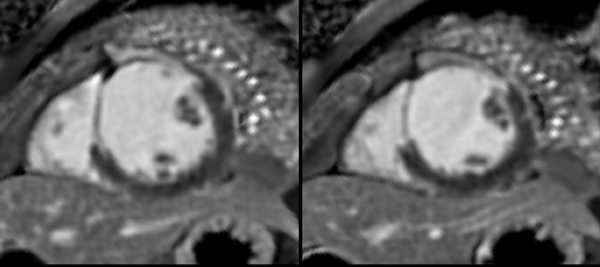 Stress Perfusion CMR