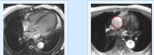 VHD Series: Mitral Regurgitation