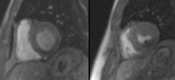 Semiquantitative perfusion analysis