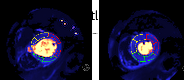 CMR quantitative perfusion