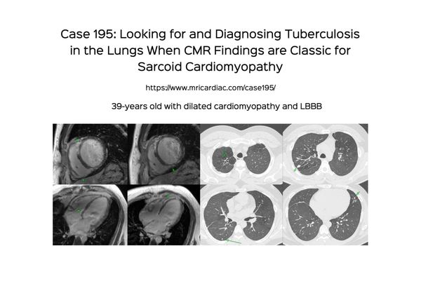 Case 195: Looking for and Diagnosing Tuberculosis in the Lungs When CMR Findings are Classic for Sarcoid Cardiomyopathy