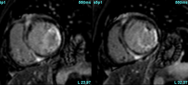 More than coronaries!