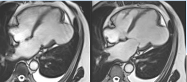 Bulge that can burst!