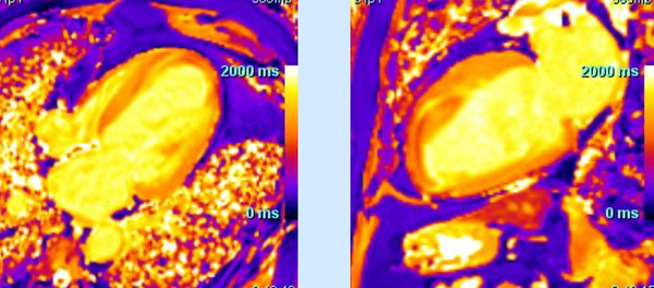 Clot in the crevice: Layered threat