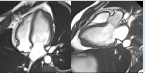 Not all hypetrophy is same!