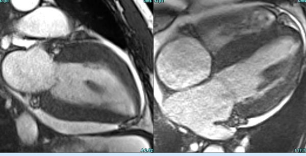 CMR for LV hypertrophy