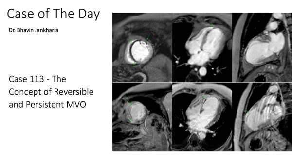 Case of the Day 113 - The Concept of Reversible and Persistent MVO