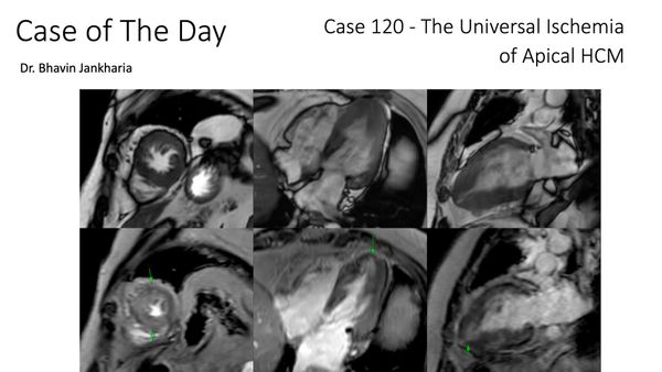 Case of the Day 120 - The Universal Ischemia of Apical HCM
