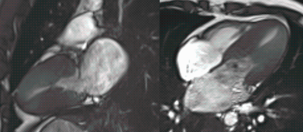 Diverse stories of same disease!