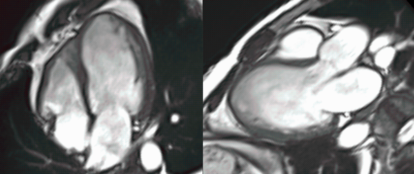 Conundrum of Ischemic DCM