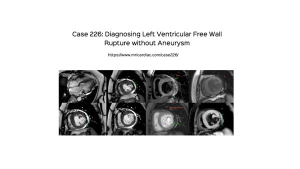 Case 226: Diagnosing Left Ventricular Free Wall Rupture without Aneurysm